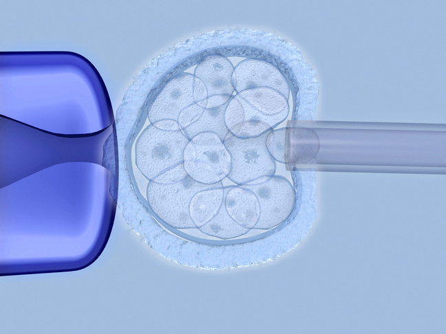 Artwork of preimplantation genetic diagnosis (PID).